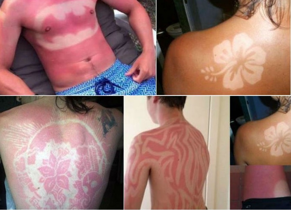 O nouă modă foarte periculoasă: arsurile solare în scop artistic